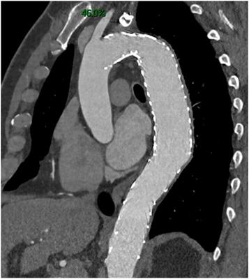 Preemptive treatment in the acute and early subacute phase of uncomplicated type B aortic dissections with poor prognosis factors